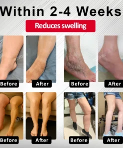 ATTDX® Advanced CVI Edema Therapy Cream
