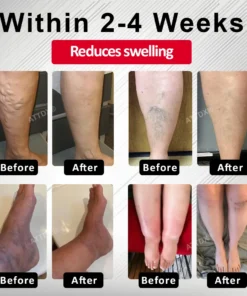 ATTDX® Advanced CVI Edema Therapy Cream