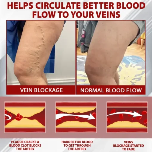 ATTDX® Advanced CVI Edema Therapy Cream