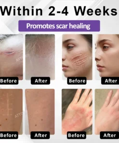 ATTDX® ClearScar Advanced Therapy Spray