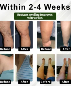 ATTDX® FluidEase Leg Therapy Edema Cream
