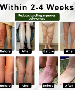ATTDX® FluidEase Leg Therapy Edema Cream