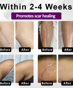 ATTDX® NanoHeal Advanced Face & Body Scar Gel
