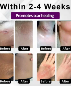 ATTDX® NanoHeal Advanced Face & Body Scar Gel
