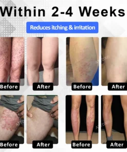 ATTDX® PsoriEase Magnesium Healing Foam