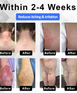 ATTDX® PsoriEase Magnesium Healing Foam